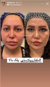 نمونه کار جراحی پلک دکتر پدرام مجاور در مشهد
