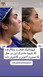 نمونه کار جراحی پلک دکتر پدرام مجاور در مشهد