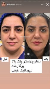نمونه کار جراحی پلک دکتر پدرام مجاور در مشهد