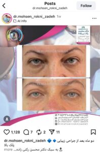 نمونه کار جراحی پلک دکتر محسن رکنی زاده در مشهد
