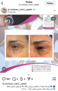 نمونه کار جراحی پلک دکتر محسن رکنی زاده در مشهد