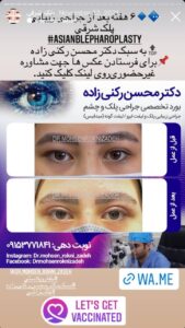 نمونه کار جراحی پلک دکتر محسن رکنی زاده در مشهد