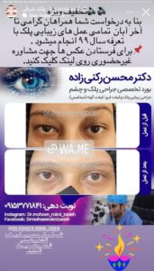 نمونه کار جراحی پلک دکتر محسن رکنی زاده در مشهد