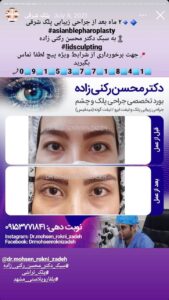 نمونه کار جراحی پلک دکتر محسن رکنی زاده در مشهد
