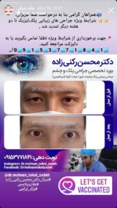نمونه کار جراحی پلک دکتر محسن رکنی زاده در مشهد