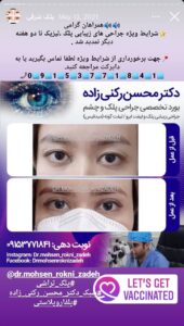 نمونه کار جراحی پلک دکتر محسن رکنی زاده در مشهد
