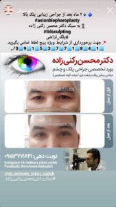 نمونه کار جراحی پلک دکتر محسن رکنی زاده در مشهد