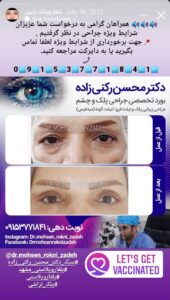 نمونه کار جراحی پلک دکتر محسن رکنی زاده در مشهد