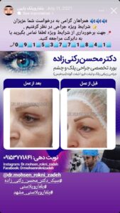 نمونه کار جراحی پلک دکتر محسن رکنی زاده در مشهد
