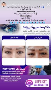 نمونه کار جراحی پلک دکتر محسن رکنی زاده در مشهد