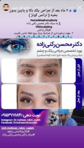 نمونه کار جراحی پلک دکتر محسن رکنی زاده در مشهد
