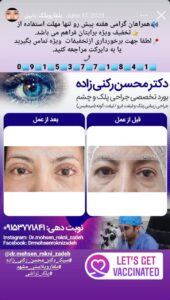 نمونه کار جراحی پلک دکتر محسن رکنی زاده در مشهد