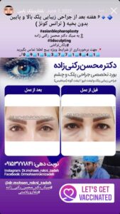 نمونه کار جراحی پلک دکتر محسن رکنی زاده در مشهد