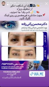 نمونه کار جراحی پلک دکتر محسن رکنی زاده در مشهد