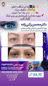 نمونه کار جراحی پلک دکتر محسن رکنی زاده در مشهد