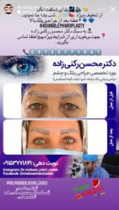 نمونه کار جراحی پلک دکتر محسن رکنی زاده در مشهد