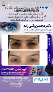 نمونه کار جراحی پلک دکتر محسن رکنی زاده در مشهد