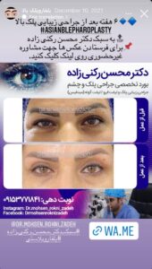 نمونه کار جراحی پلک دکتر محسن رکنی زاده در مشهد