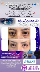 نمونه کار جراحی پلک دکتر محسن رکنی زاده در مشهد