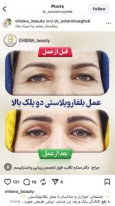 نمونه کار جراحی پلک دکتر ستاره ثاقب در مشهد