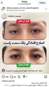 نمونه کار جراحی پلک دکتر ستاره ثاقب در مشهد