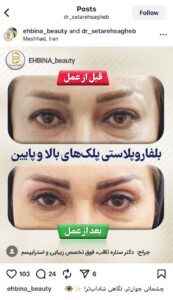 نمونه کار جراحی پلک دکتر ستاره ثاقب در مشهد