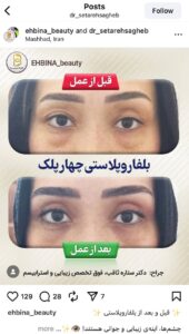نمونه کار جراحی پلک دکتر ستاره ثاقب در مشهد