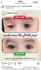 نمونه کار جراحی پلک دکتر ستاره ثاقب در مشهد