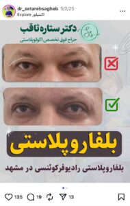 نمونه کار جراحی پلک دکتر ستاره ثاقب در مشهد