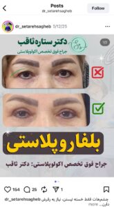 نمونه کار جراحی پلک دکتر ستاره ثاقب در مشهد