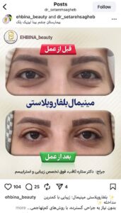 نمونه کار جراحی پلک دکتر ستاره ثاقب در مشهد