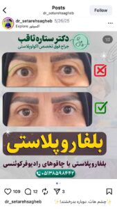نمونه کار جراحی پلک دکتر ستاره ثاقب در مشهد
