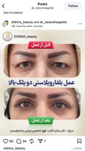 نمونه کار جراحی پلک دکتر ستاره ثاقب در مشهد