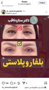 نمونه کار جراحی پلک دکتر ستاره ثاقب در مشهد
