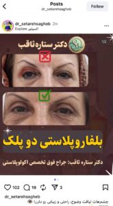 نمونه کار جراحی پلک دکتر ستاره ثاقب در مشهد