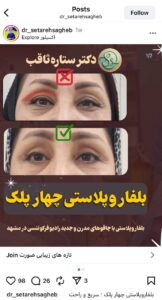 نمونه کار جراحی پلک دکتر ستاره ثاقب در مشهد