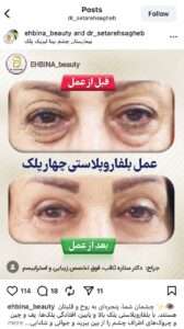 نمونه کار جراحی پلک دکتر ستاره ثاقب در مشهد