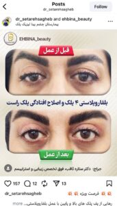 نمونه کار جراحی پلک دکتر ستاره ثاقب در مشهد