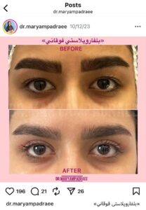 نمونه کار جراحی پلک دکتر مریم پادرایی در مشهد