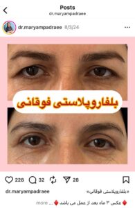 نمونه کار جراحی پلک دکتر مریم پادرایی در مشهد
