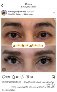 نمونه کار جراحی پلک دکتر مریم پادرایی در مشهد