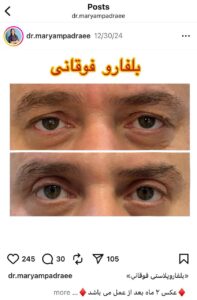 نمونه کار جراحی پلک دکتر مریم پادرایی در مشهد