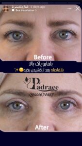 نمونه کار جراحی پلک دکتر مریم پادرایی در مشهد