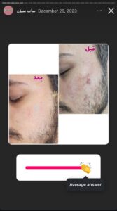 نمونه کار پوست دکتر الهه اندخشیده در مشهد