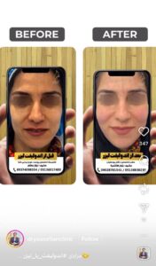 نمونه کار پوست دکتر یوسفیان مقدم در مشهد