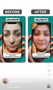 نمونه کار پوست دکتر یوسفیان مقدم در مشهد
