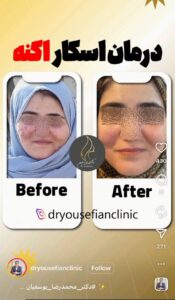 نمونه کار پوست دکتر یوسفیان مقدم در مشهد
