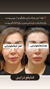 نمونه کار هایفوتراپی (کلینیک لاغری طراوت)