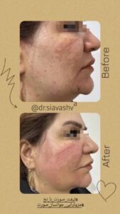 نمونه کار لیفت با نخ (دکتر سیاوش وکیلی)