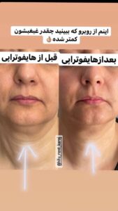 نمونه کار هایفوتراپی (کلینیک لاغری طراوت)